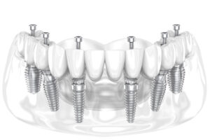 all on 6 dental implant model before its screwed in