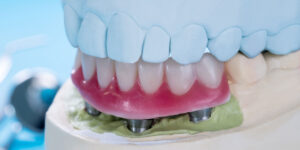 implant supported dentures that show 3 of the 4 implants