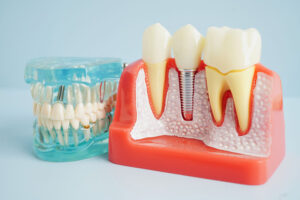 a cutaway of the jaw showing an implant and a model of a full arch of teeth