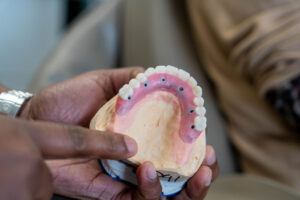full arch dental implants with 6 holes for implants to be placed
