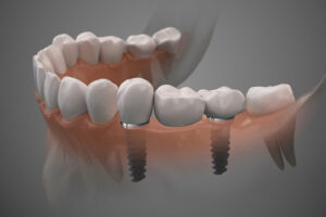 2 implants that are placed into the jaw with a crown on top