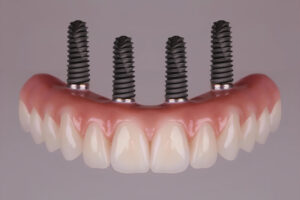 all on 4 dental implants with a full set of teeth
