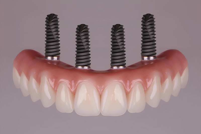 all on 4 dental implants with a full set of teeth