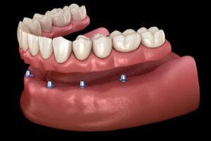 all on 4 denture implants with a full arch of teeth going across it