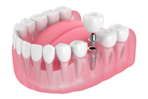 a single dental implant with a crown and an abutment floating above it