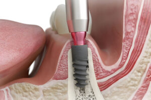 a single dental implant cutaway model with the jaw bone exposed and the gum line shown