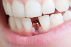 a single dental implant that needs a crown placed on top of it