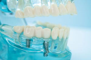 a couple of single implants placed inside the jaw model