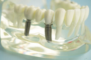2 single dental implants placed into the clear jaw model