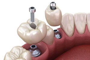 2 single dental implants with crowns going on top of each of the abutments
