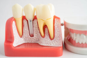 a dental implant tooth model with a full arch of teeth next to it