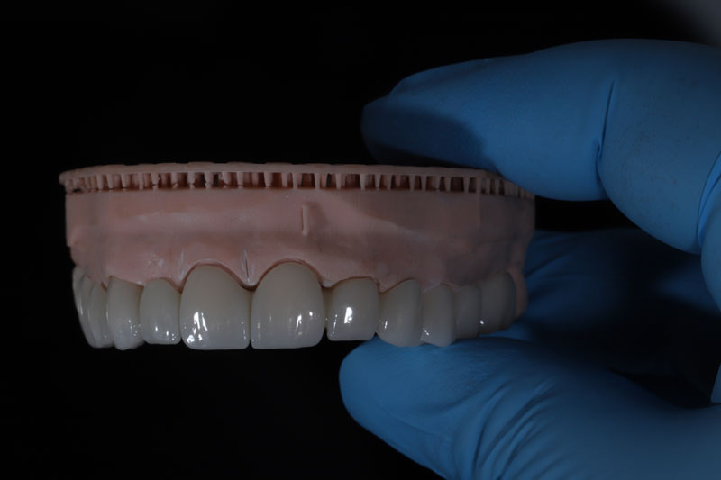 full arch of dental implants with a full arch of teeth going across it