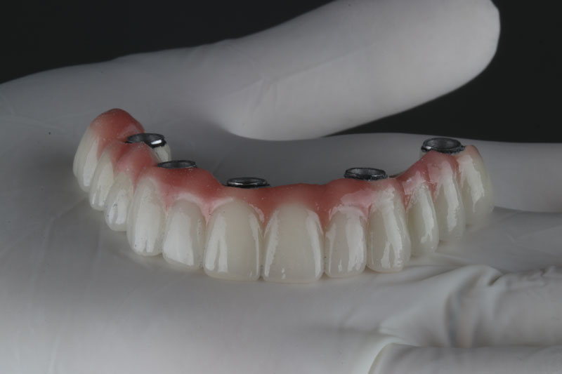 a full arch of teeth with holes for implants to be placed
