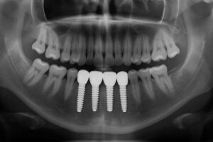 An x-ray of a mouth showing dental implant posts fully integrated into the jawbone, supporting artificial teeth. No text on the image.