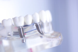 Dentist and patient discussing full mouth dental implants in a modern dental office